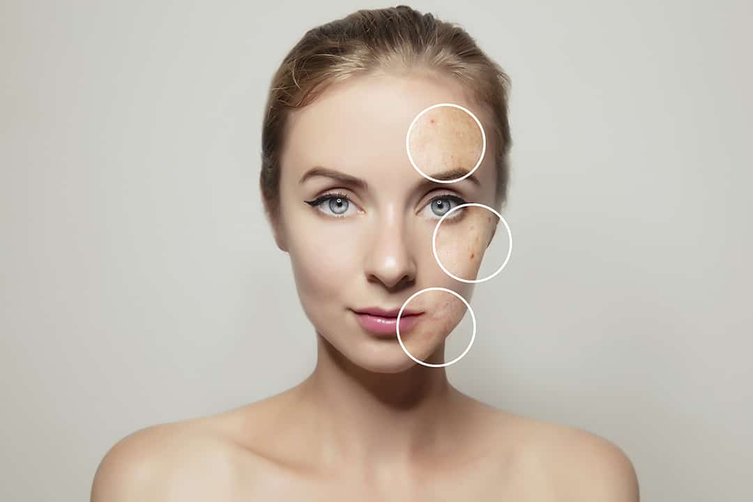 woman face portrait with clear and pimpled skin